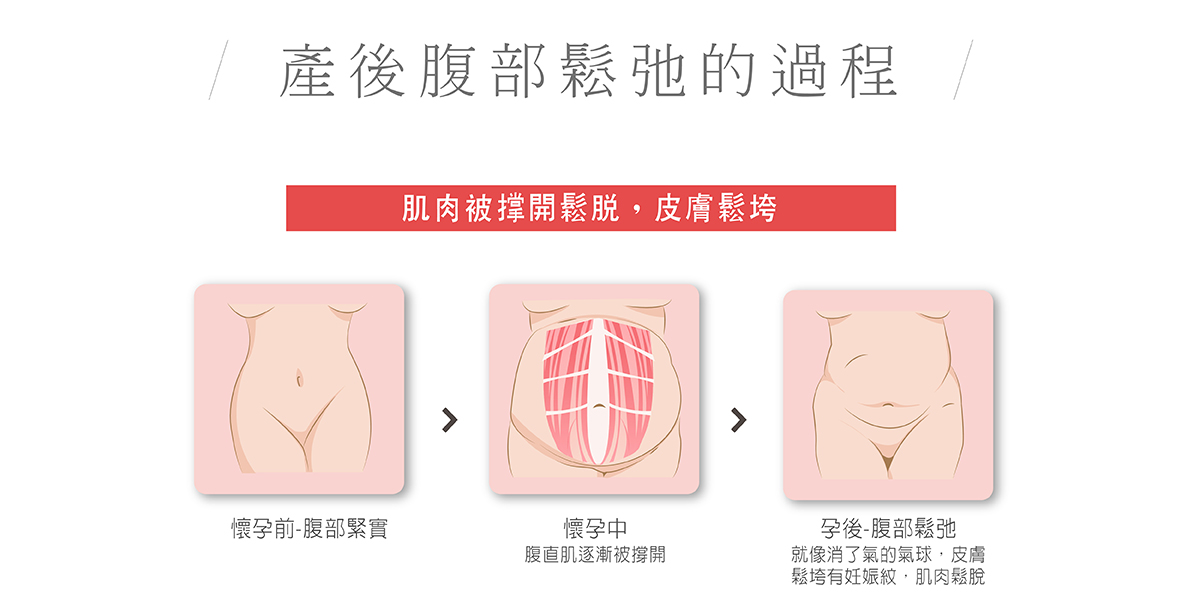 腹部拉皮手术 台中教主医美整形外科诊所bishopclinic