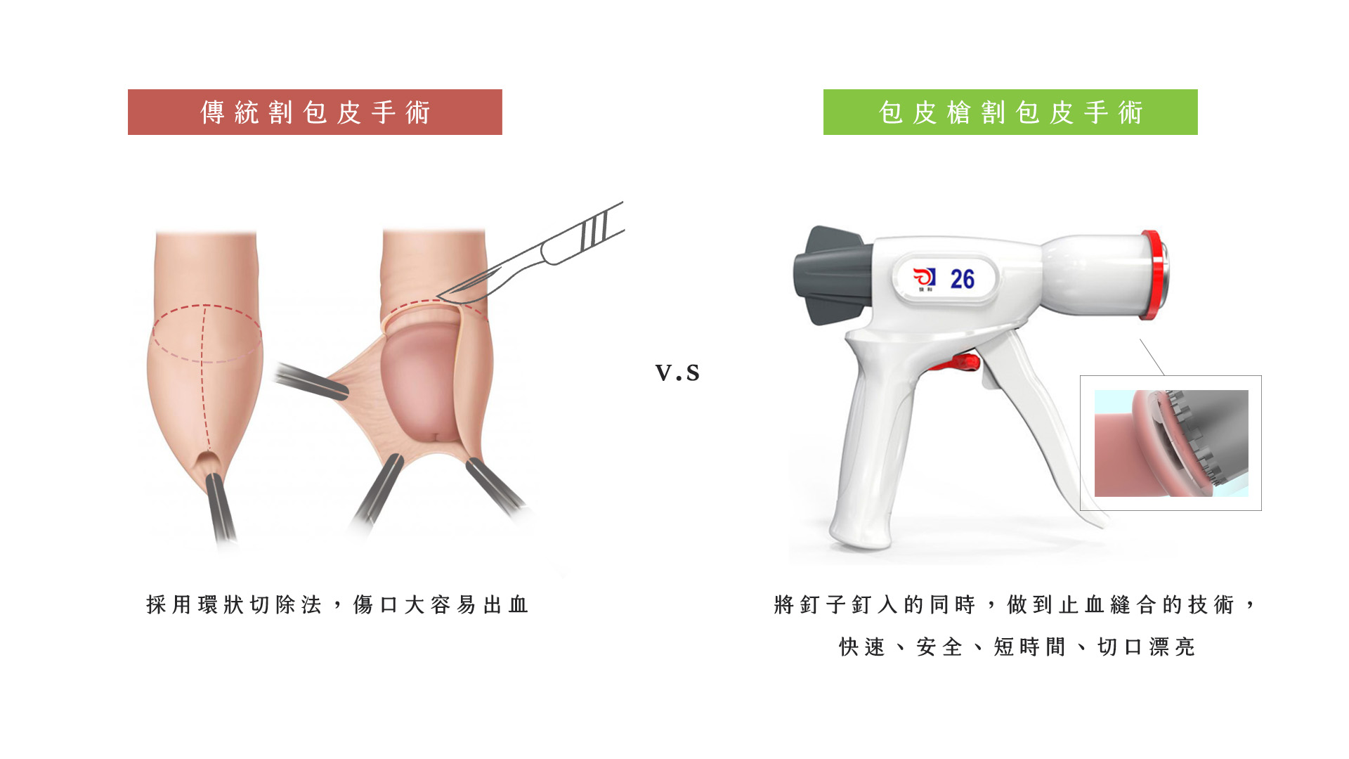 男性 器 修正