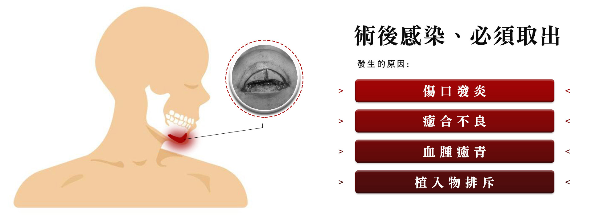 墊下巴狀況（3）墊下巴手術術後感染、必須取出