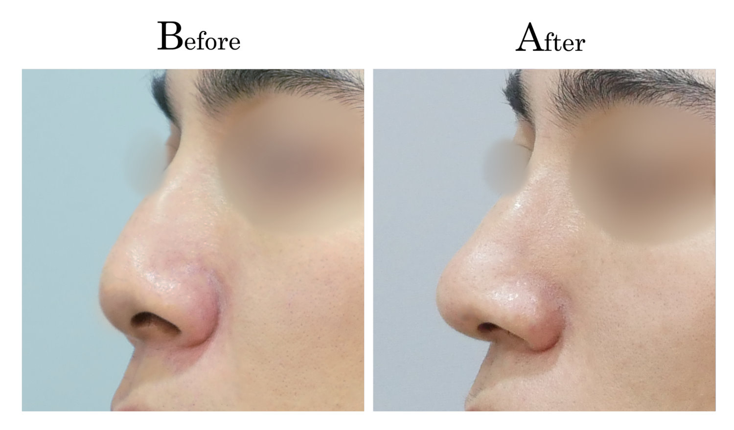 鼻頭塑型墊鼻頭手術2_2