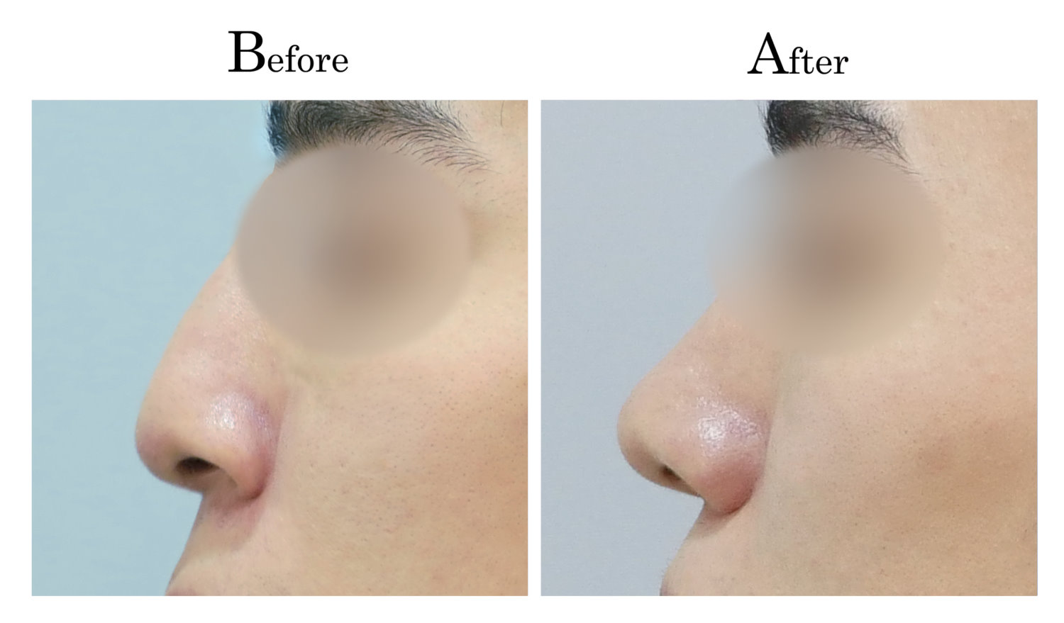 鼻頭塑型墊鼻頭手術2_3