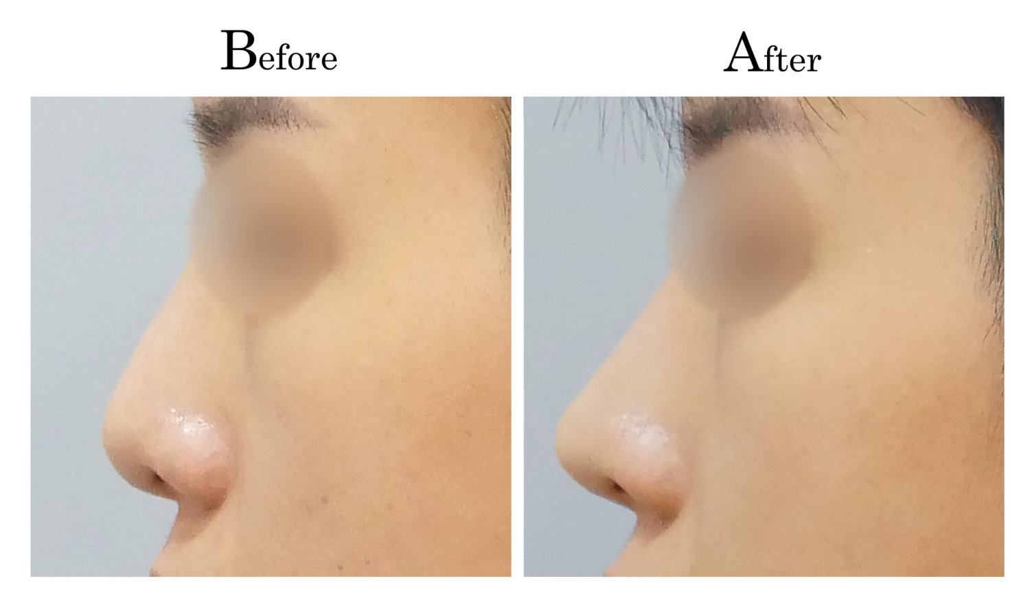 鼻頭塑型墊鼻頭手術7_3