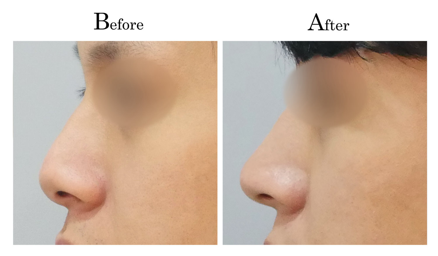 鼻頭塑型墊鼻頭手術9_3