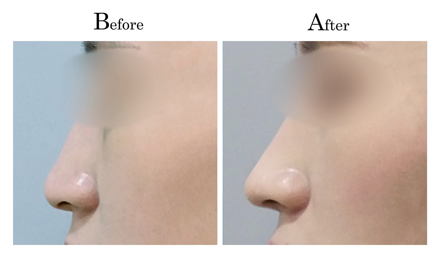 鼻頭塑型墊鼻頭手術1_3