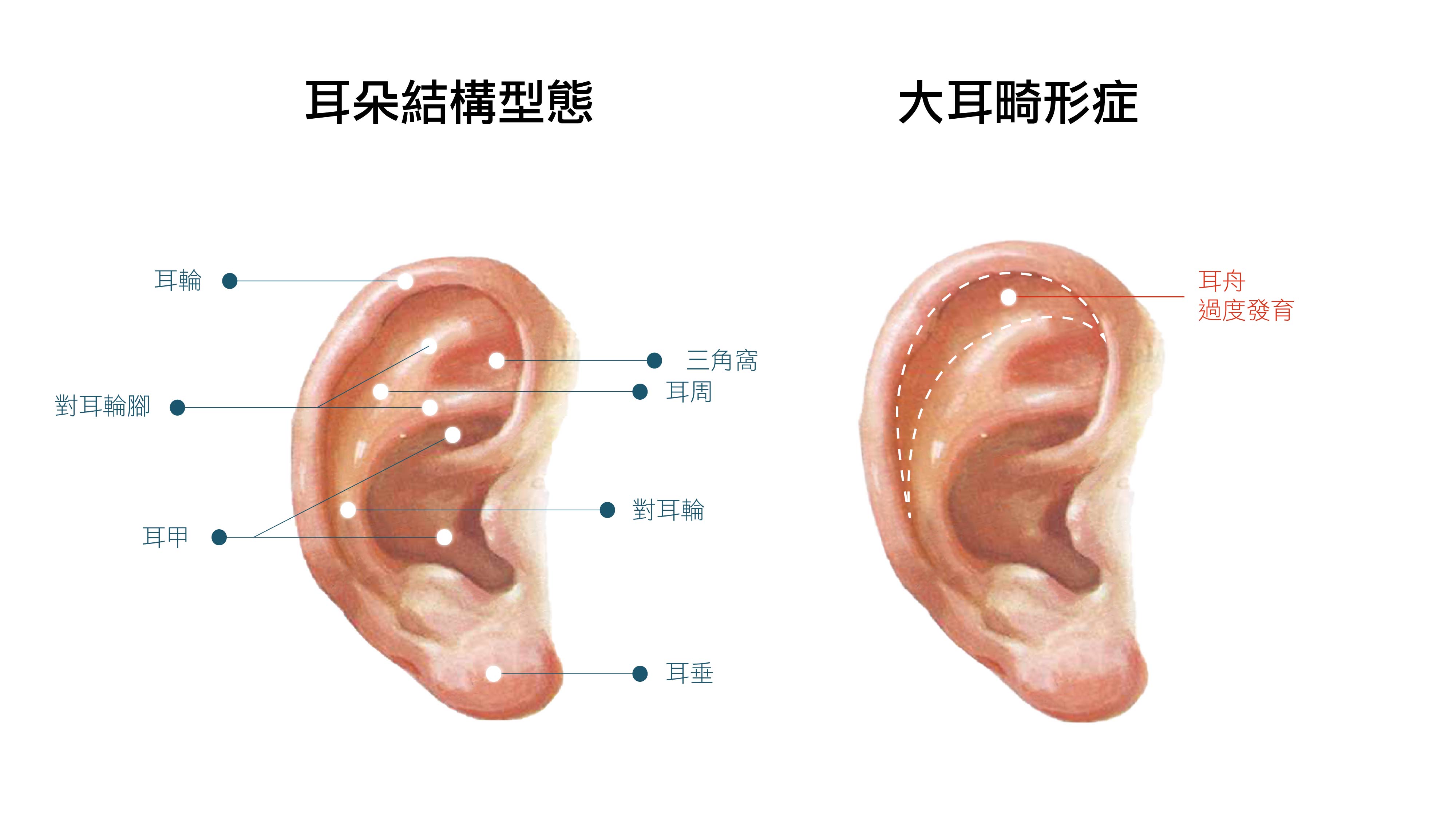 耳朵整形大耳朵縮小手術004