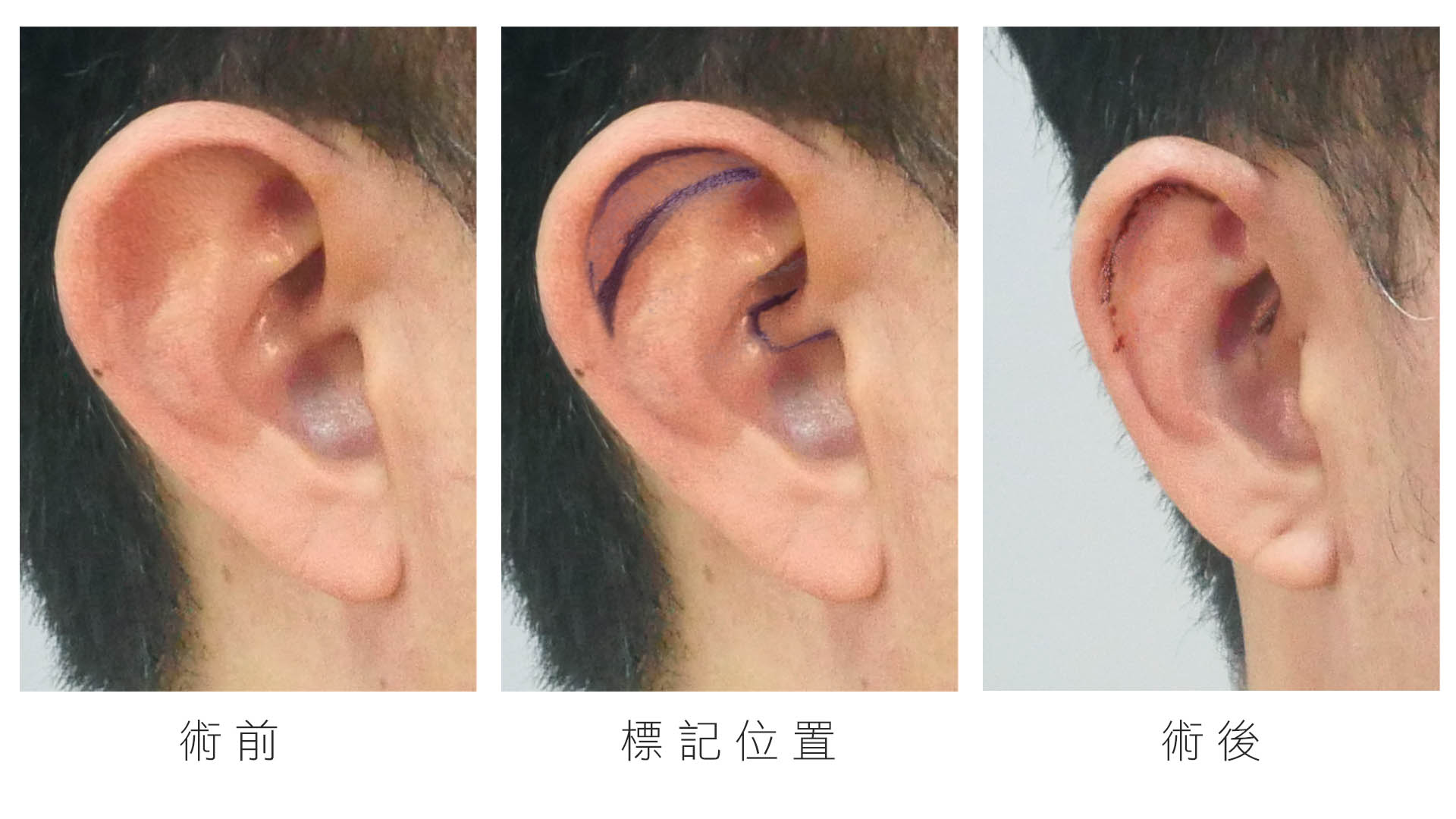 耳朵整形大耳朵縮小手術005