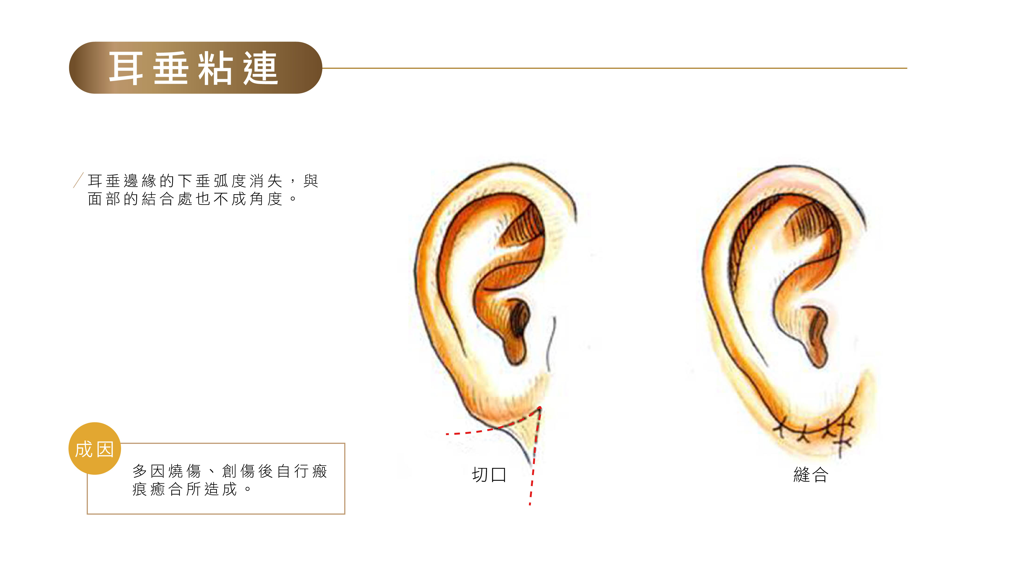 景丽峰医生：耳垂修复手术多大可以做？图解几种耳垂畸形修复术！ - 知乎