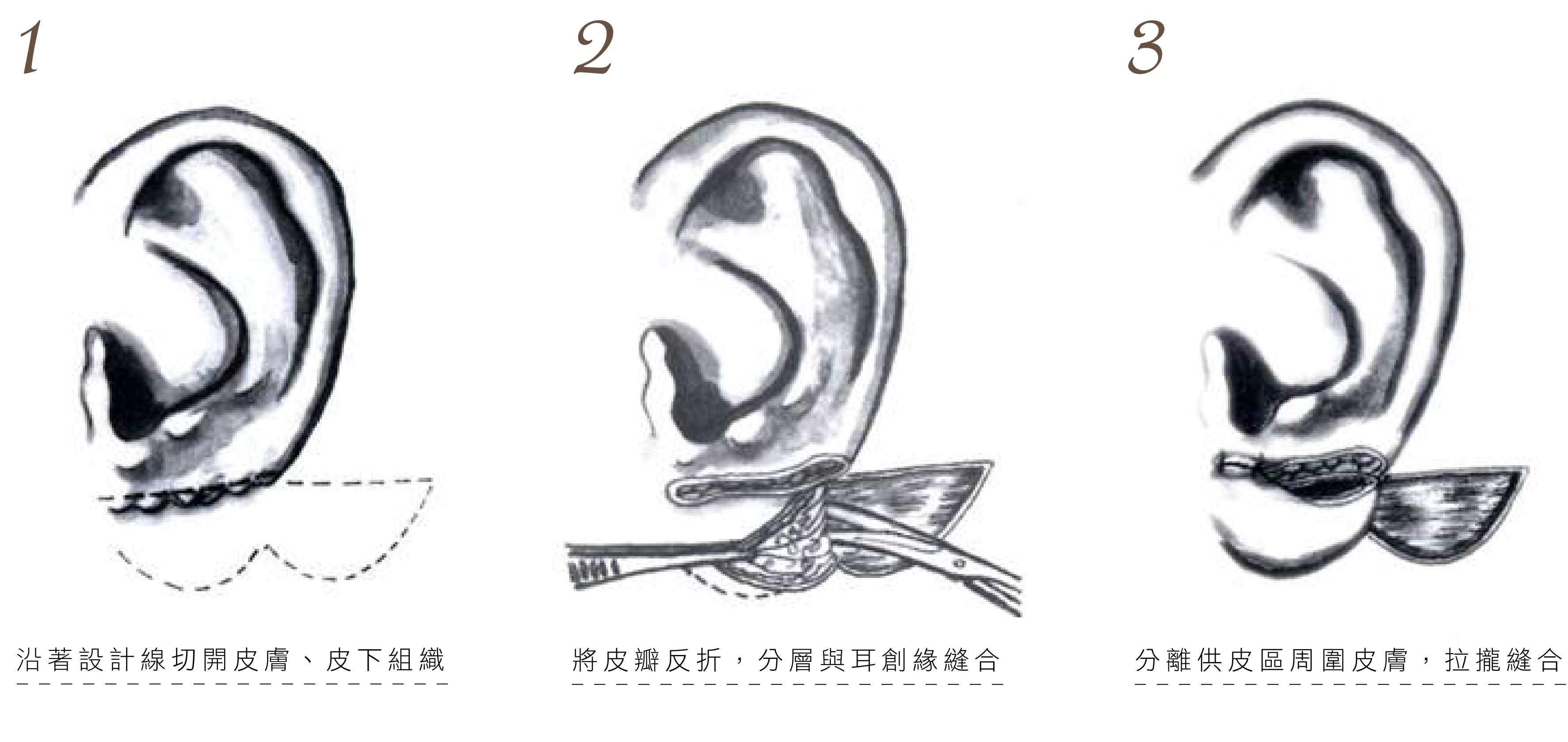 耳廓畸形图片及名称 - 哔哩哔哩