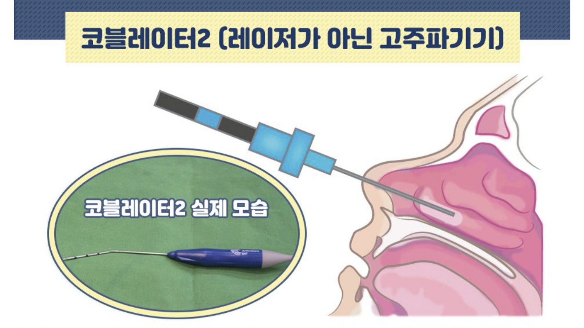 台中鼻塞手術RF無線射頻微創鼻塞手術權威醫師何旭爵002