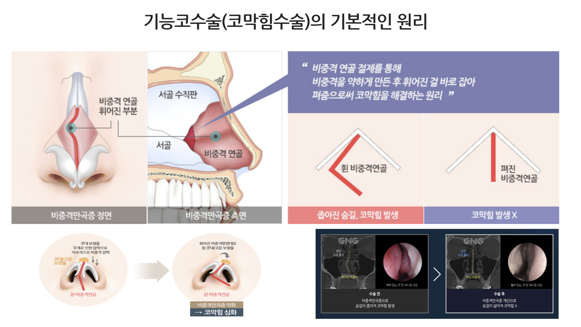 台中鼻塞手術RF無線射頻微創鼻塞手術權威醫師何旭爵003