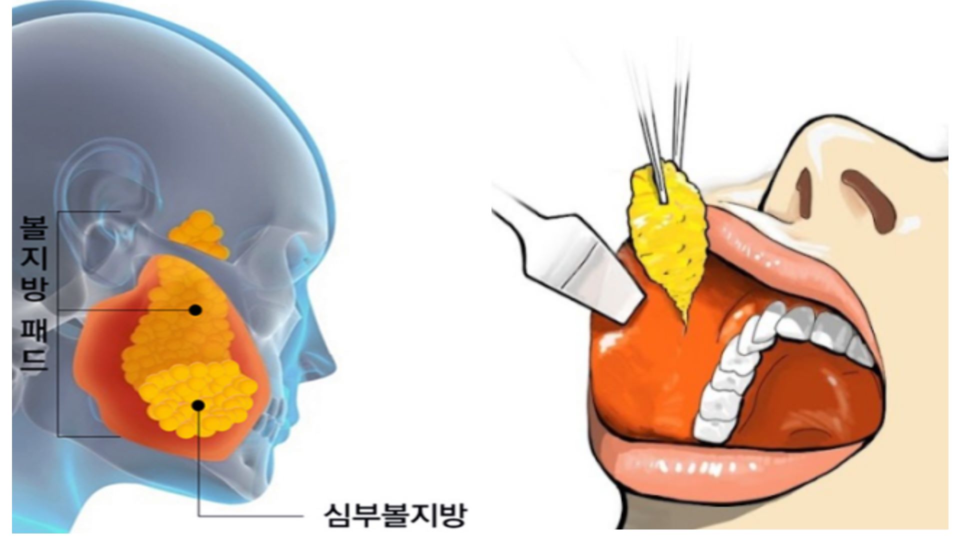 取口內脂肪台中權威醫師推薦價格費用002