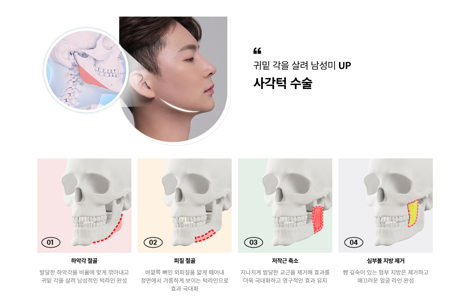 台中墊下顎輪廓線手術 下顎輪廓線重塑手術推薦醫師診所