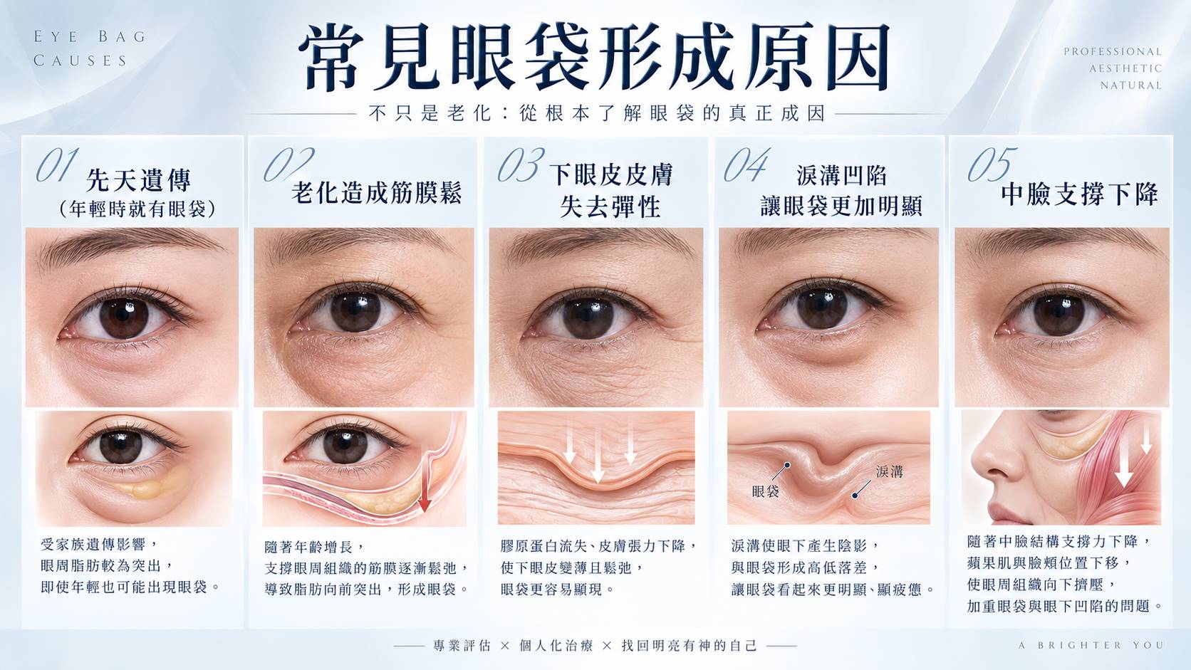 常見眼袋形成原因 - 台中教主醫美