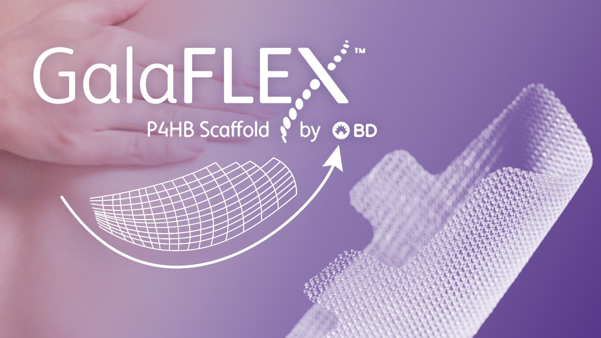 GalaFLEX?乳房支撐網廣泛應用於全球乳房整形和重建手術，專為強化、穩定和支撐乳房組織而設計，是一種在手術過程中植 入的乳房支撐網。